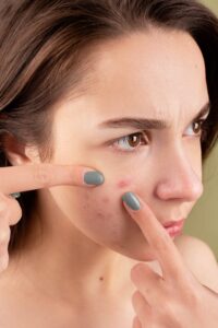 Feiten en fabels over acne