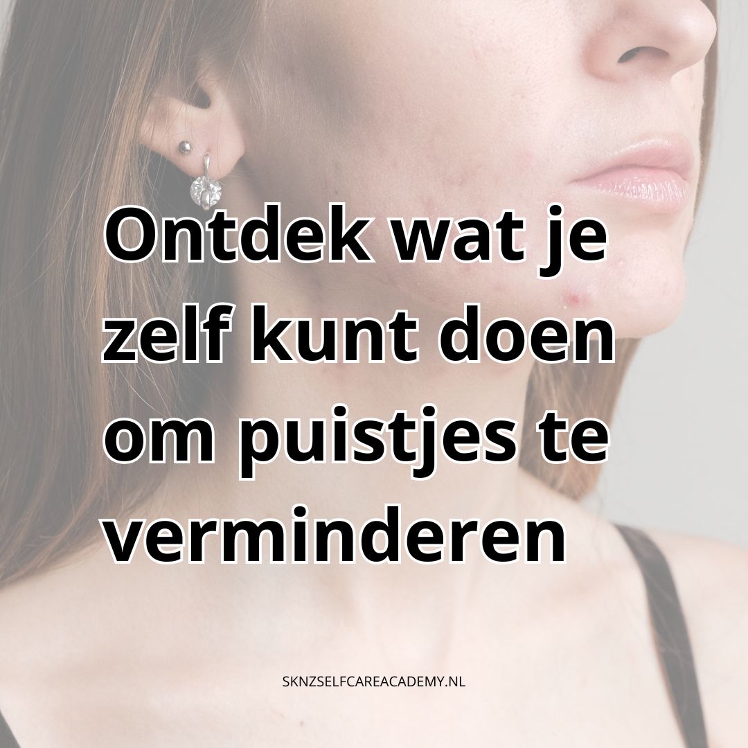 Je bekijkt nu Ontdek wat je zelf kunt doen om puistjes te verminder.