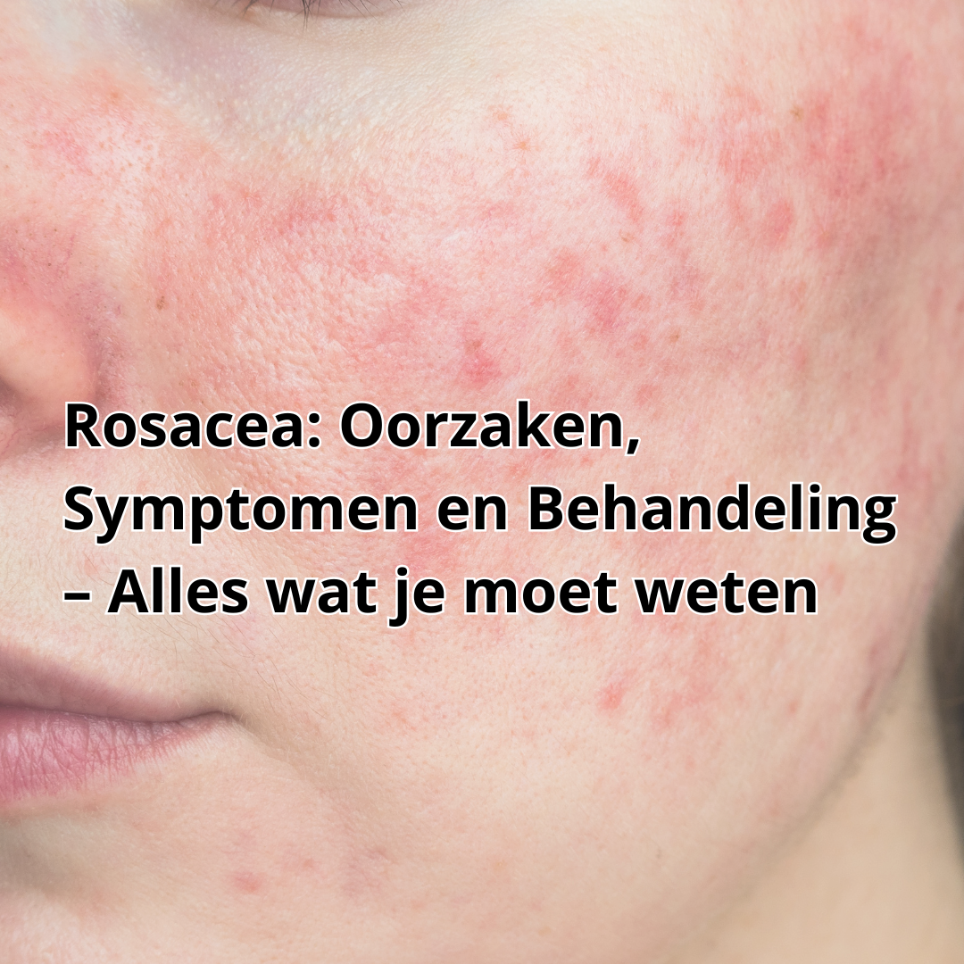 Rosacea: Oorzaken, Symptomen en Behandeling – Alles wat je moet weten