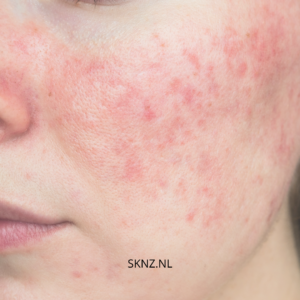 Rosacea: Oorzaken, Symptomen en Behandeling – Alles wat je moet weten